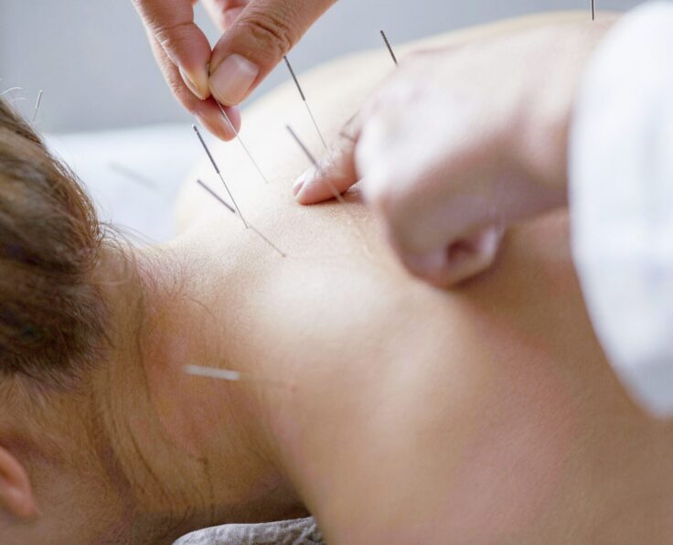 9 Acupuncture1